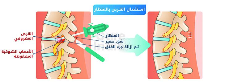 التنظير الداخلي